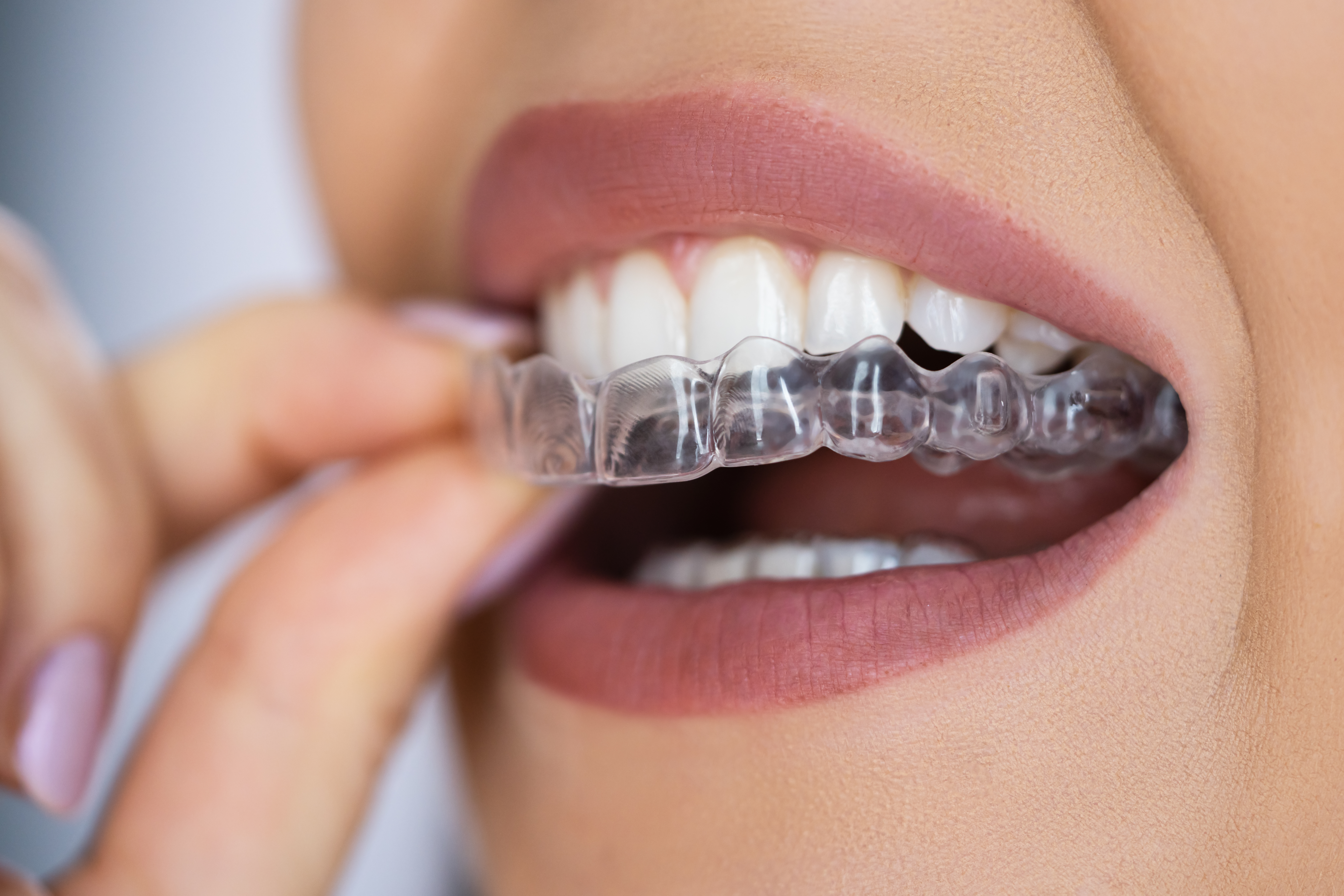 How to Get the Most Out of Invisalign