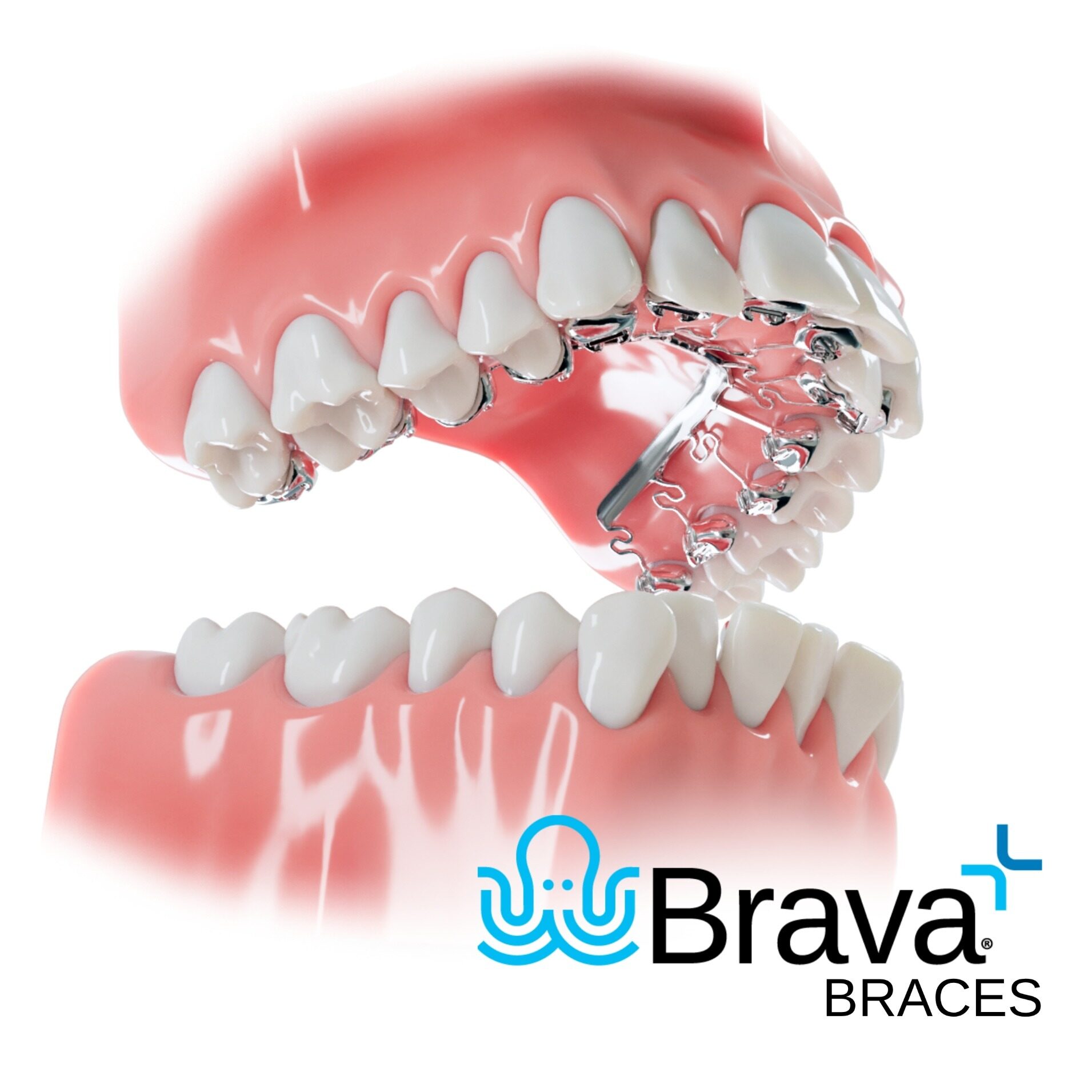 Brava-hidden-braces-upper-invisible (1)
